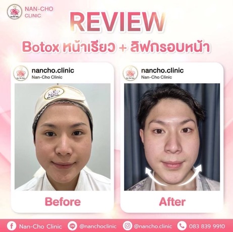 Nan-Cho Clinic (MRT Wat Mangkon Exit 3) Nan-Cho Clinic (MRT Wat Mangkon Exit 3) - นันโช่ คลินิก ความงามระดับมืออาชีพ ย่านเยาวราช image_picker_8C0E9341-D3C1-4014-9203-55D25441537E-3659-000000D2F550F28A