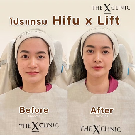 The X Clinic (JAS Green Village Ramkhamhaeng) The X Clinic (Jas Green Village) - ดิ เอ็กซ์ คลินิก บริการเสริมความงามครบวงจร รามคำแหง image_picker_AD9D49BA-B361-4592-986E-AB20A0B79DB3-19495-0000195F2F463B79
