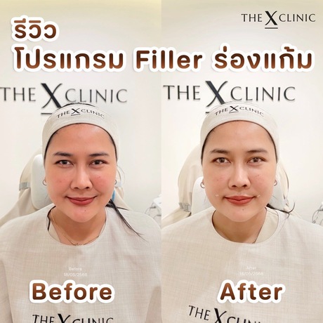The X Clinic (JAS Green Village Ramkhamhaeng) The X Clinic (Jas Green Village) - ดิ เอ็กซ์ คลินิก บริการเสริมความงามครบวงจร รามคำแหง image_picker_7B10E71E-25F3-46AE-B083-612977142BC0-19495-0000195F2F4C56F3