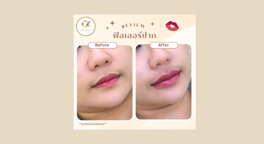 Ozona Wellnesz Clinic Ozona Wellnesz Clinic - โอโซน่าเวลเนสคลินิก คลินิกความงาม ชุมพร 5