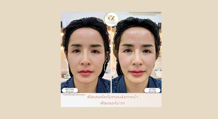 Ozona Wellnesz Clinic Ozona Wellnesz Clinic - โอโซน่าเวลเนสคลินิก คลินิกความงาม ชุมพร 6