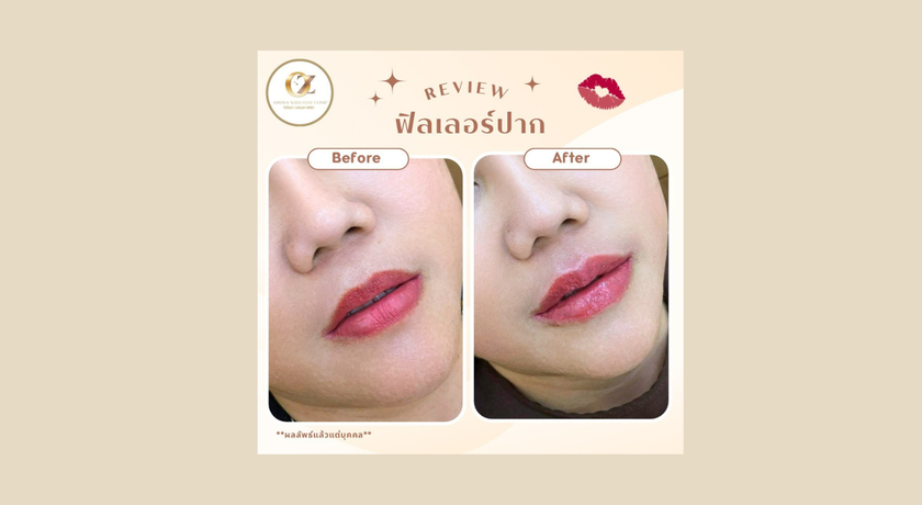 Ozona Wellnesz Clinic Ozona Wellnesz Clinic - โอโซน่าเวลเนสคลินิก คลินิกความงาม ชุมพร 9