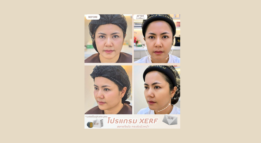 Ozona Wellnesz Clinic Ozona Wellnesz Clinic - โอโซน่าเวลเนสคลินิก คลินิกความงาม ชุมพร 10