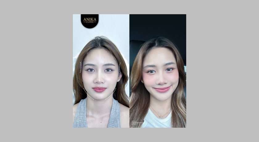 Anika Clinic (Sattahip) Anika Clinic (Sattahip) - อณิกา คลินิกเวชกรรม สาขาสัตหีบ คลินิกความงาม สัตหีบ 9