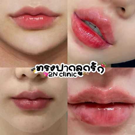 2N Clinic 2N Clinic - ทูเอ็นคลินิก เสริมความงาม เชียงใหม่ scaled_1000003437
