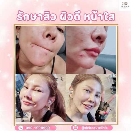 De Beaut Clinic (Prasert-Manukitch 48) De Beaut Clinic (Prasert-Manukitch 48) - เดอบิ้ว คลินิกเวชกรรม บริการความงามครบวงจร ย่านบึงกุ่ม scaled_1000001852