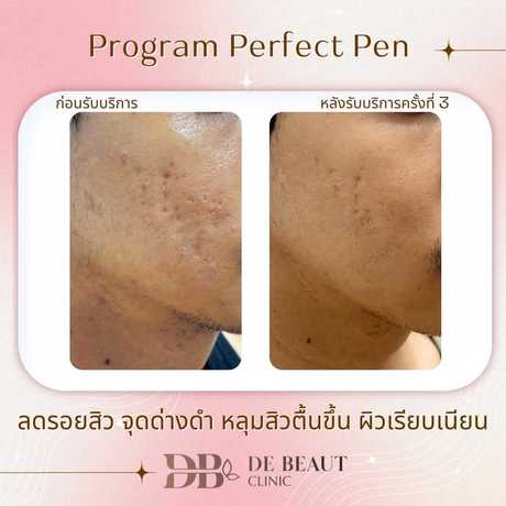 De Beaut Clinic (Prasert-Manukitch 48) De Beaut Clinic (Prasert-Manukitch 48) - เดอบิ้ว คลินิกเวชกรรม บริการความงามครบวงจร ย่านบึงกุ่ม scaled_1000001853