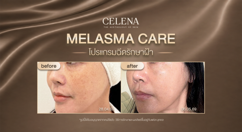 CELENA Clinic (Sukhumvit 26) CELENA Clinic (Sukhumvit 26) - เซเลน่า คลินิก สุขุมวิท 26 %E0%B9%82%E0%B8%9B%E0%B8%A3%E0%B9%81%E0%B8%81%E0%B8%A3%E0%B8%A1%E0%B8%A3%E0%B8%B1%E0%B8%81%E0%B8%A9%E0%B8%B2%E0%B8%9D%E0%B9%89%E0%B8%B21%E0%B8%84%E0%B8%B8%E0%B8%93%E0%B8%81%E0%B8%B5%E0%B8%A7%E0%B8%B5%E0%B9%88_copy