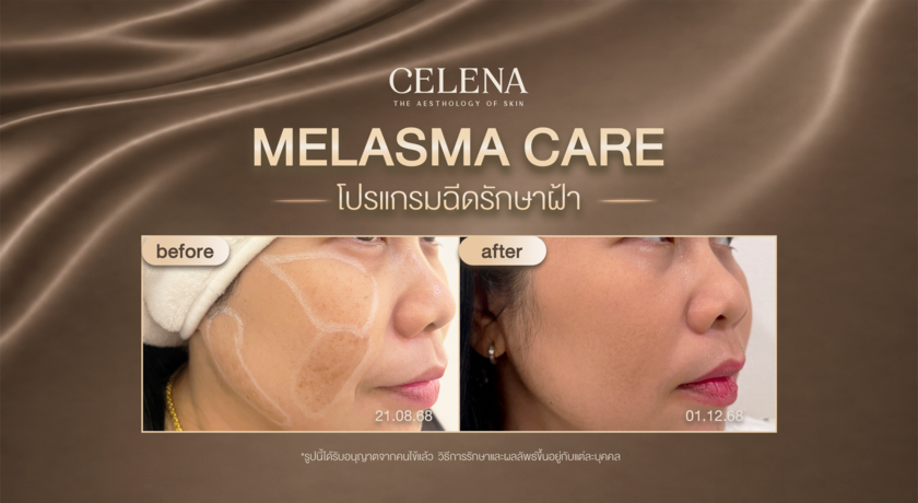 CELENA Clinic (Sukhumvit 26) CELENA Clinic (Sukhumvit 26) - เซเลน่า คลินิก สุขุมวิท 26 %E0%B9%82%E0%B8%9B%E0%B8%A3%E0%B9%81%E0%B8%81%E0%B8%A3%E0%B8%A1%E0%B8%A3%E0%B8%B1%E0%B8%81%E0%B8%A9%E0%B8%B2%E0%B8%9D%E0%B9%89%E0%B8%B24%E0%B8%84%E0%B8%B8%E0%B8%93%E0%B8%99%E0%B9%89%E0%B8%AD%E0%B8%87_copy