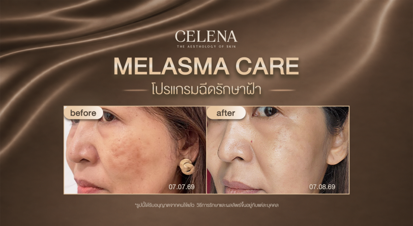CELENA Clinic (Sukhumvit 26) CELENA Clinic (Sukhumvit 26) - เซเลน่า คลินิก สุขุมวิท 26 %E0%B9%82%E0%B8%9B%E0%B8%A3%E0%B9%81%E0%B8%81%E0%B8%A3%E0%B8%A1%E0%B8%A3%E0%B8%B1%E0%B8%81%E0%B8%A9%E0%B8%B2%E0%B8%9D%E0%B9%89%E0%B8%B25%E0%B8%84%E0%B8%B8%E0%B8%93%E0%B8%AE%E0%B8%B2%E0%B8%99%E0%B8%B0_copy