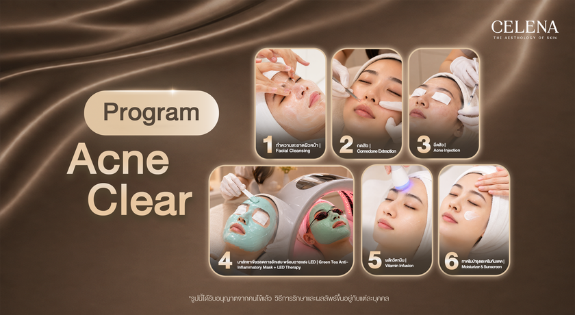 CELENA Clinic (Sukhumvit 26) CELENA Clinic (Sukhumvit 26) - เซเลน่า คลินิก สุขุมวิท 26 Acne_Clear_%E0%B9%82%E0%B8%81%E0%B8%A7%E0%B8%B2%E0%B8%9A%E0%B8%B4_copy