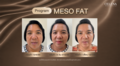 Meso_Fat